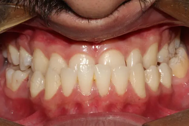 Cross Bite Treatment