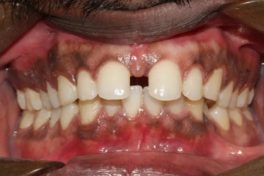 Diastema Treatment